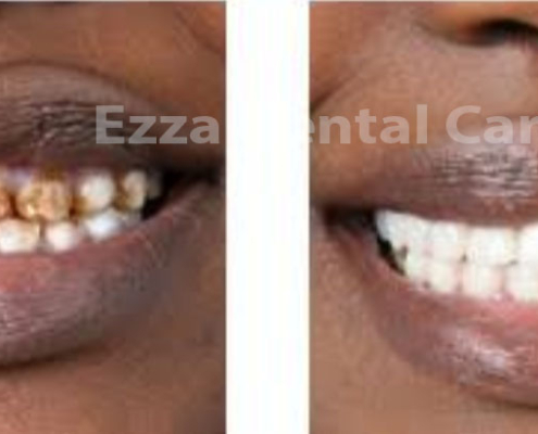 Teeth Stains and their look after treatment