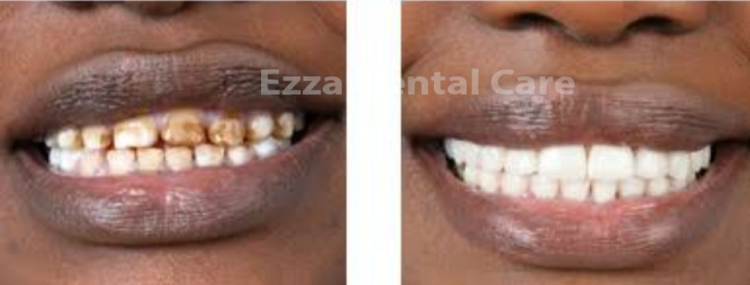 Teeth Stains and their look after treatment