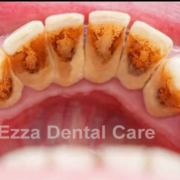 Teeth affected by gum disease