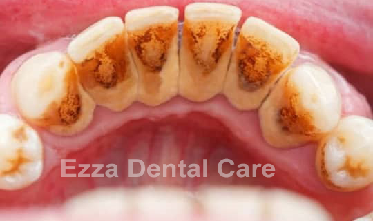 Teeth affected by gum disease