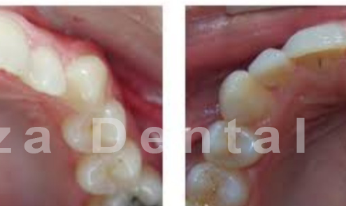 misaligned teeth