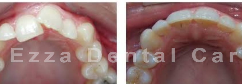 misaligned teeth