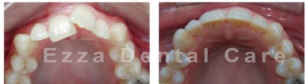 Misaligned Teeth Causes Effects And Treatment Options Ezza Dental Care 2565