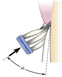 Image showing stillman technique of brushing teeth