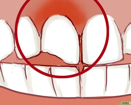 Cracked or Broken tooth