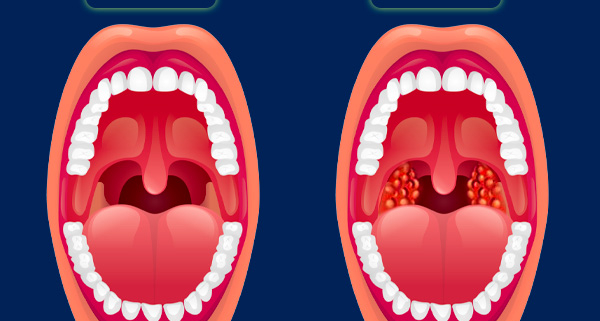 tonsilitis