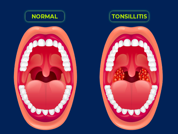 tonsillitis-and-oral-health-ezza-dental-care