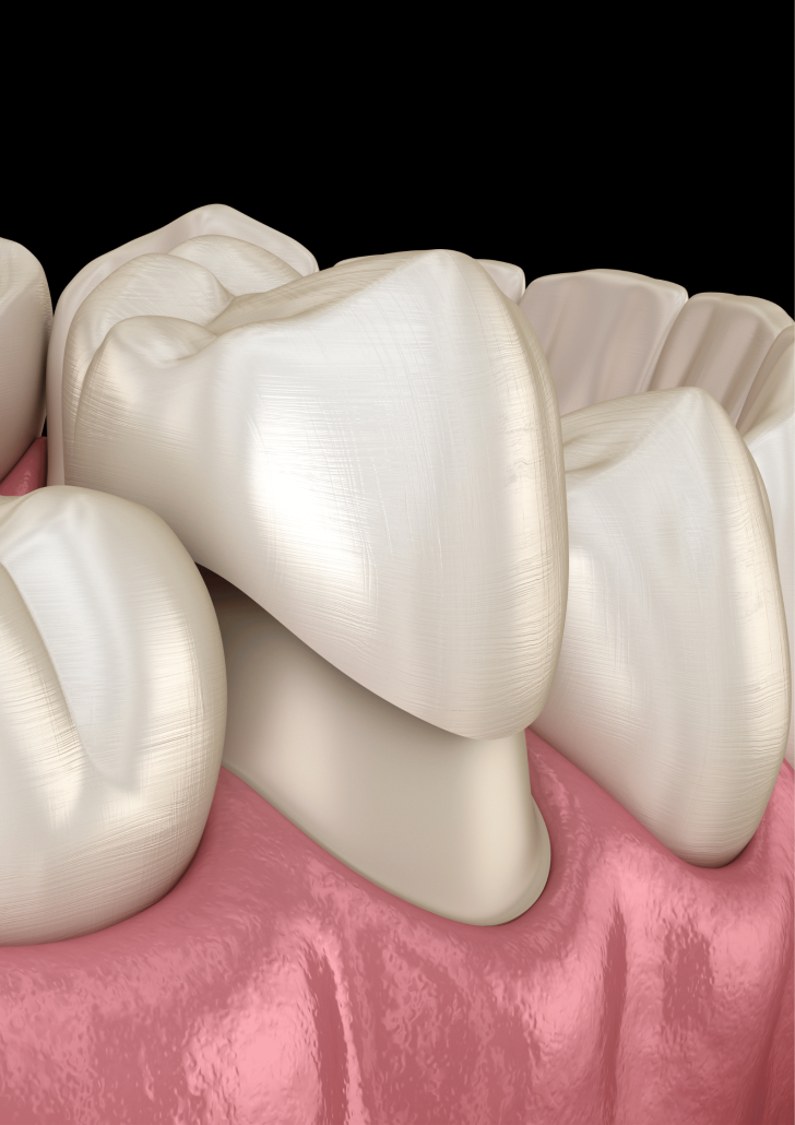 Dental crowns