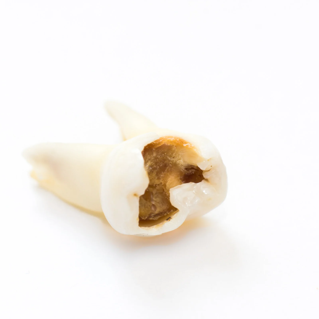 Worms eat teeth! 10 risk factors for dental caries, causes and a sure